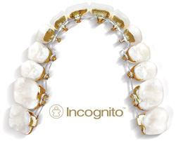 Incognito Braces Cost- Masri Orthodontics Services