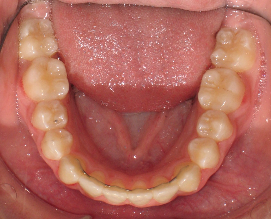 Toronto orthodontist Invisalign lower lingual retainer