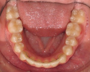 Toronto-orthodontist-Invisalign-lower-lingual-retainer