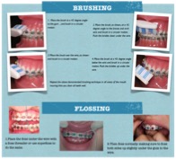 Oral hygiene instructions with braces