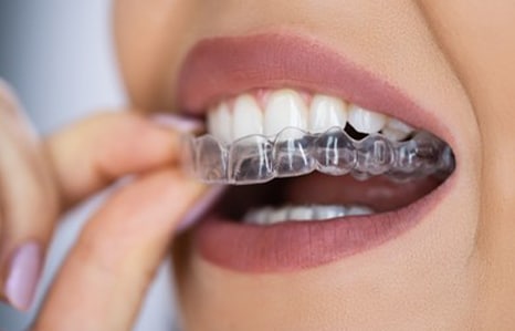 Clear aligners Orthodontics at Don Mills in Toronto, ON